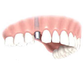 Implante dental