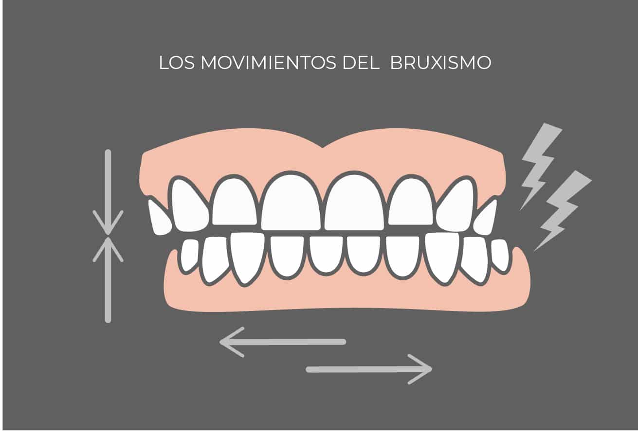 Movimientos de la dentadura con bruxismo