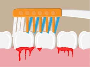 Sangrado de encías es un indicio de enfermedad periodontal